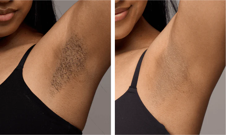 Close-up of handheld IPL hair removal device designed for safe at-home treatments