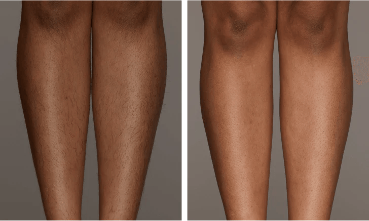 Intense pulsed light hair removal device targeting hair follicles for smoother skin
